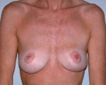 Breast Implant Removal