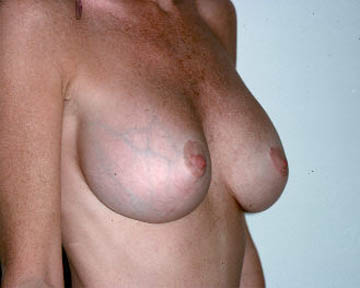 Breast Implant Removal before and after photo