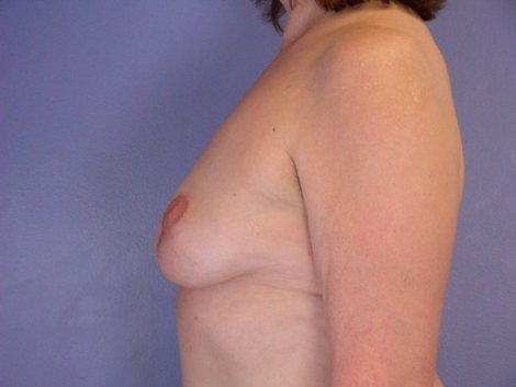 Breast Implant Removal before and after photo