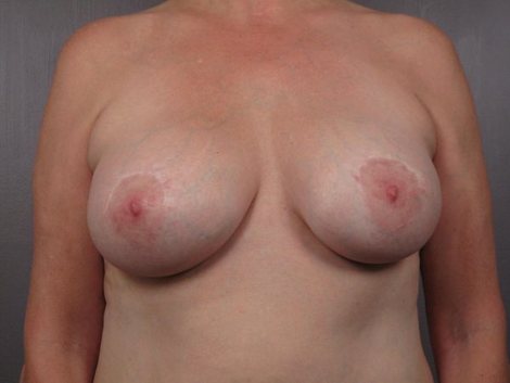 Breast Implant Removal before and after photo