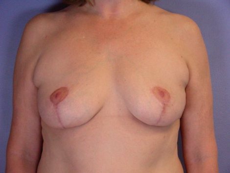 Breast Implant Removal before and after photo