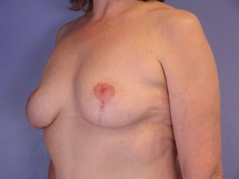 Breast Implant Removal before and after photo