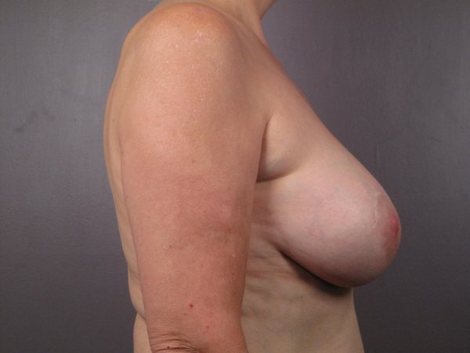 Breast Implant Removal before and after photo