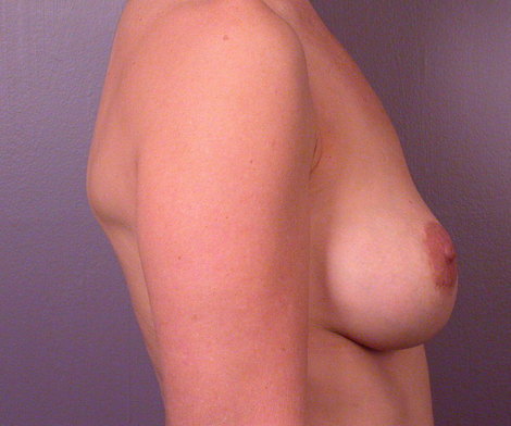 Breast Asymmetry Correction before and after photo