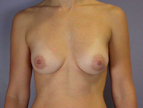 Breast Asymmetry Correction before and after photo