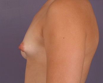 Breast Asymmetry Correction before and after photo