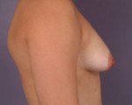 Breast Asymmetry Correction Before and after photo