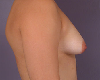 Breast Asymmetry Correction before and after photo