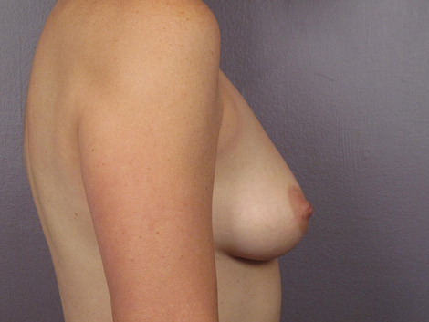 Breast Asymmetry Correction before and after photo