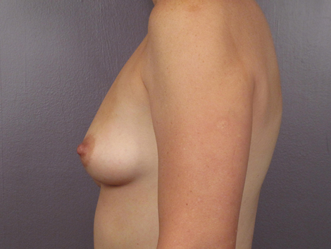 Breast Asymmetry Correction before and after photo