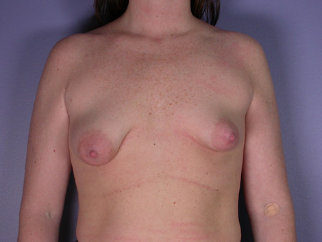 Breast Asymmetry Correction before and after photo