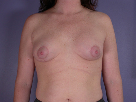 Breast Asymmetry Correction before and after photo