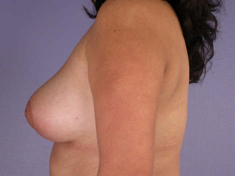 Breast Asymmetry Correction before and after photo