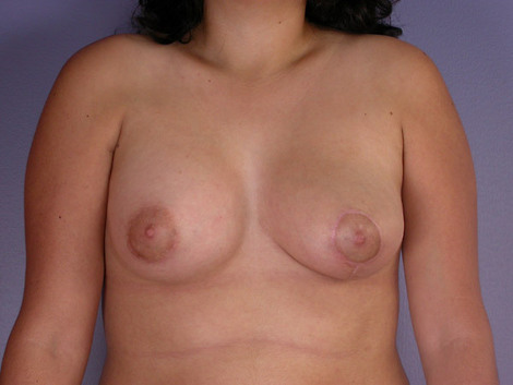 Breast Asymmetry Correction before and after photo