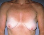 Breast Asymmetry Correction Before and after photo