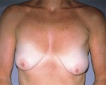 Breast Asymmetry Correction