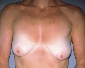 Breast Asymmetry Correction before and after photo