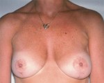 Breast Asymmetry Correction