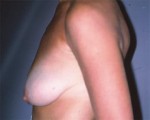 Breast Asymmetry Correction
