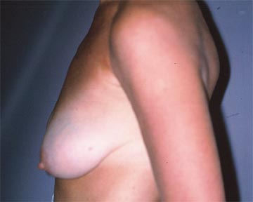 Breast Asymmetry Correction before and after photo