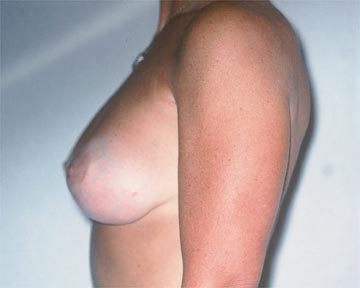 Breast Asymmetry Correction before and after photo