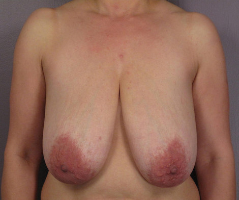 Breast Lift before and after photo