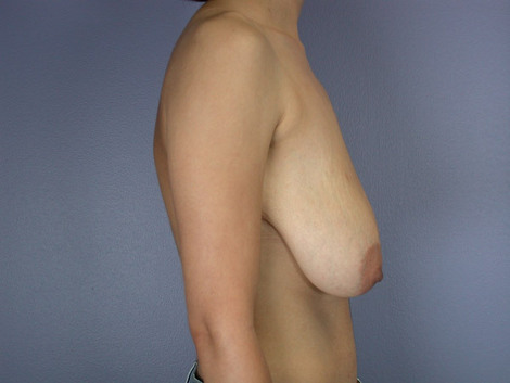 Breast Lift before and after photo