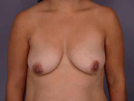 Breast Lift before and after photo