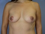 Breast Lift Before and after photo