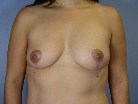 Breast Lift before and after photo