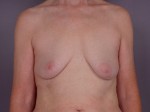 Breast Lift with Augmentation Before and after photo