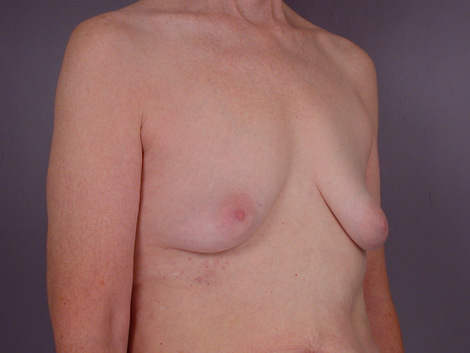 Breast Lift with Augmentation before and after photo