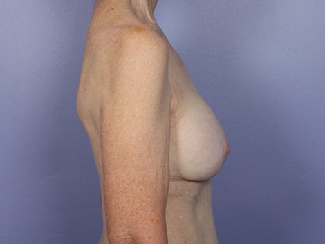 Breast Lift with Augmentation before and after photo