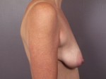 Breast Lift with Augmentation