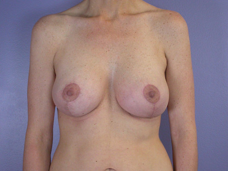 Breast Lift with Augmentation before and after photo