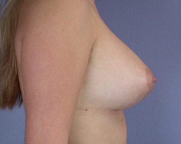 Breast Lift with Augmentation before and after photo