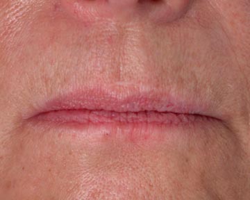 Lip Augmentation before and after photo