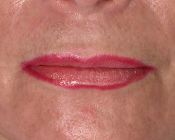 Lip Augmentation before and after photo