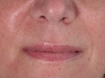 Lip Augmentation Before and after photo