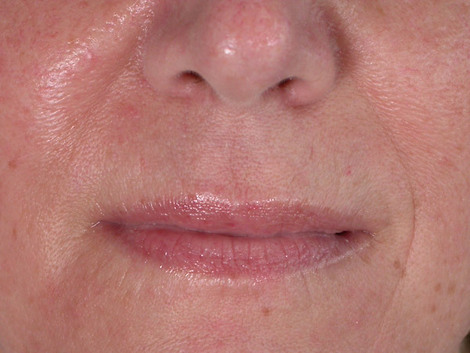 Lip Augmentation before and after photo