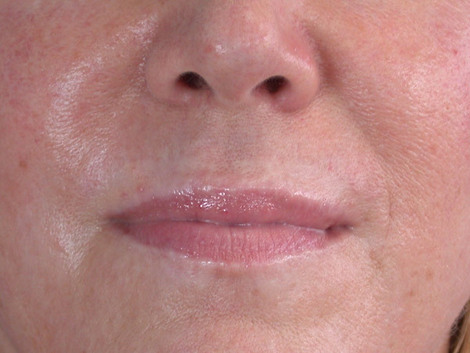 Lip Augmentation before and after photo