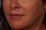 Lip Augmentation