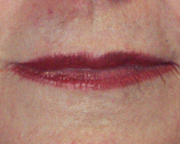 Lip Augmentation before and after photo