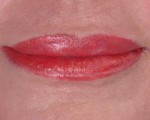 Lip Augmentation