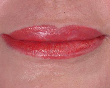 Lip Augmentation before and after photo