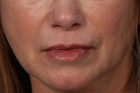 Lip Augmentation before and after photo