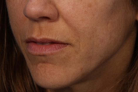 Lip Augmentation before and after photo