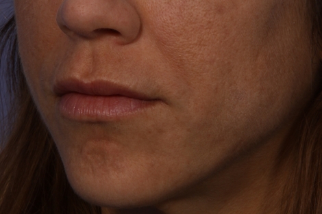 Lip Augmentation before and after photo