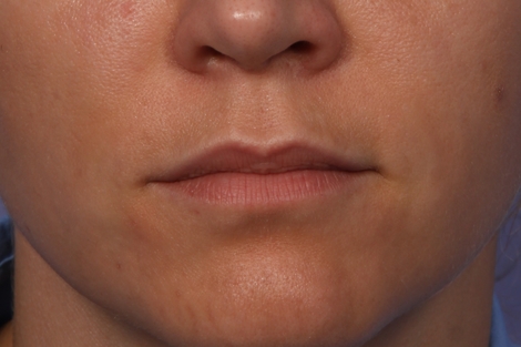 Lip Augmentation before and after photo