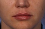 Lip Augmentation Before and after photo
